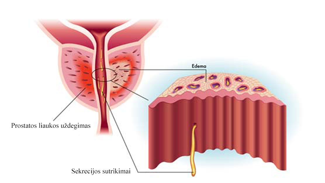 prostatos liga ir erekcija