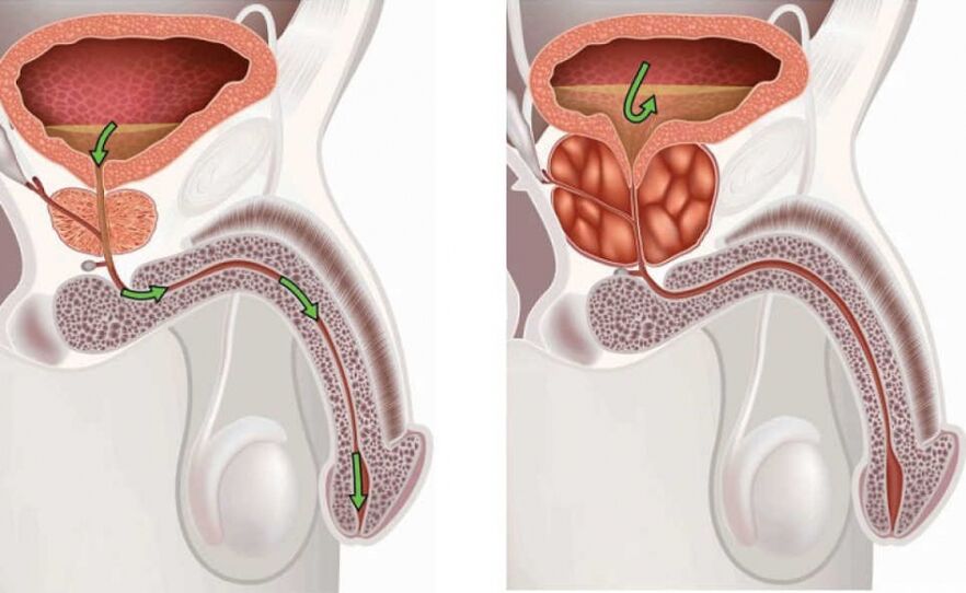 prostatos liga ir erekcija zingsnis po zingsnio narys dideja