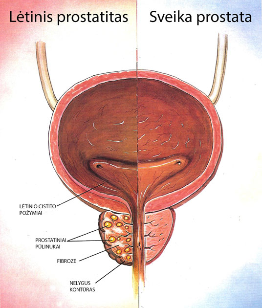 prostata sumažina erekciją