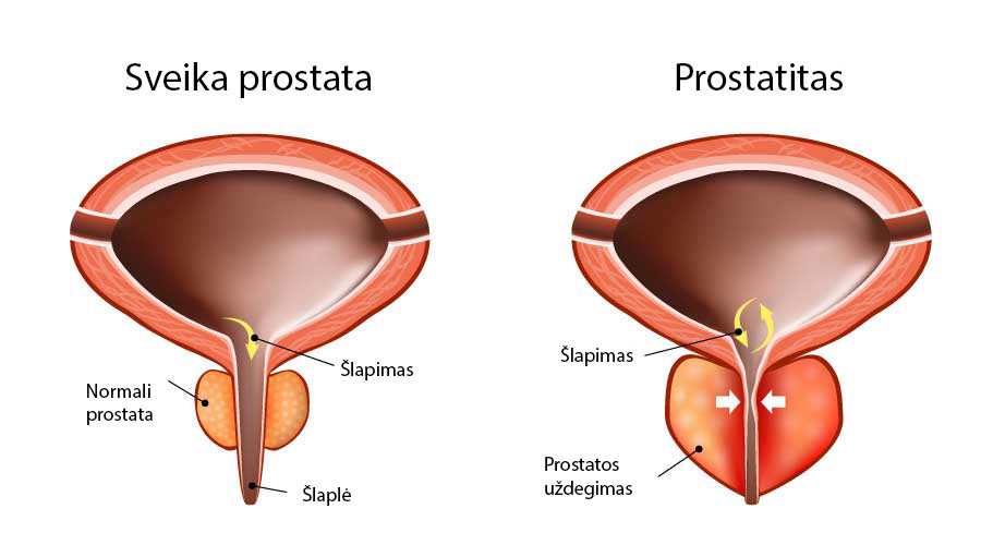 silpnos erekcijos prostatito gydymas kaip suprasti varpą